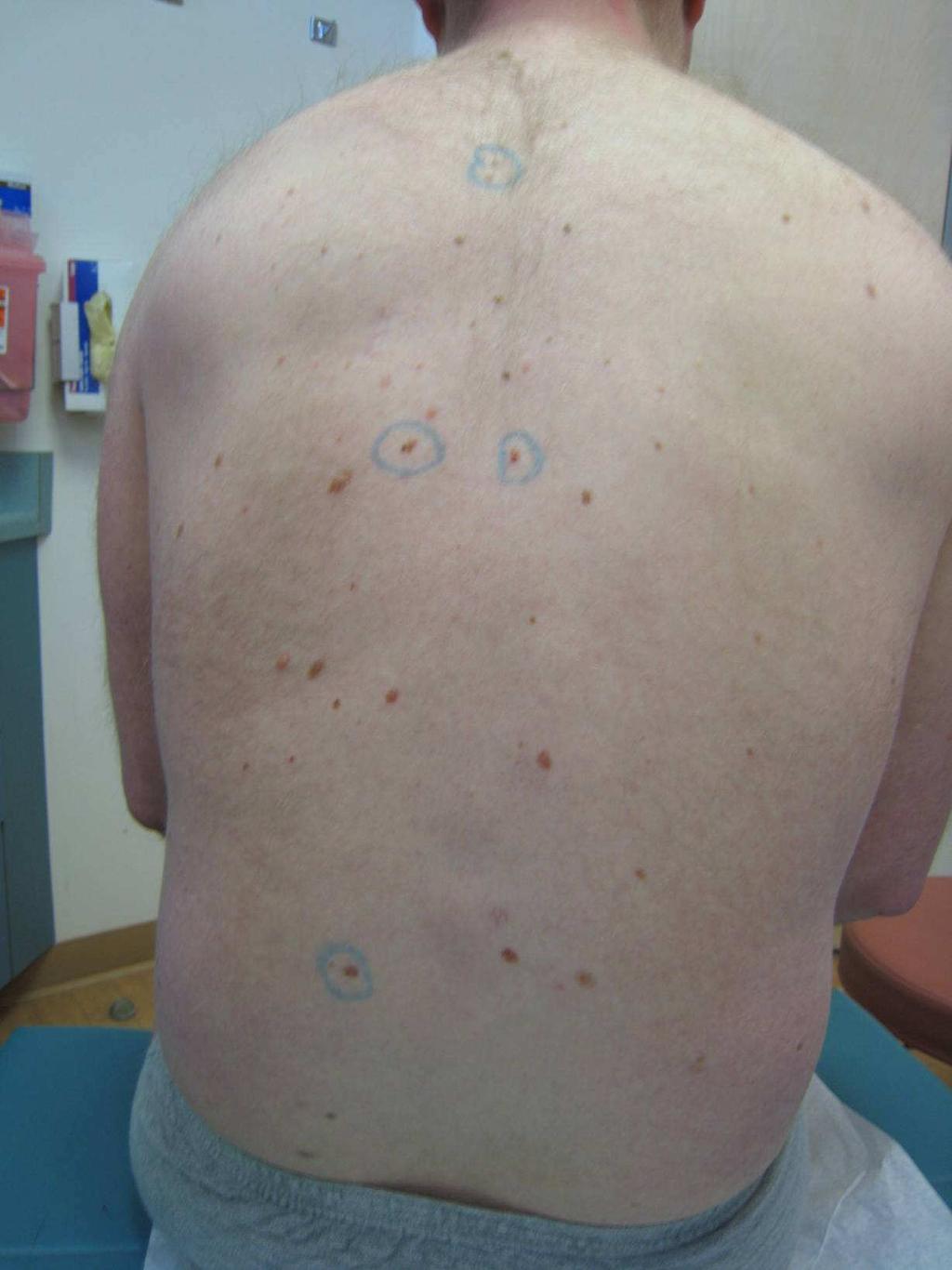 Clinical Features of FAMMM Often numerous nevi (30-100+) Nevi > 6mm in diameter New nevi appear throughout life (after age 30) Nevi in sun-protected areas (buttocks, breasts of females) Family