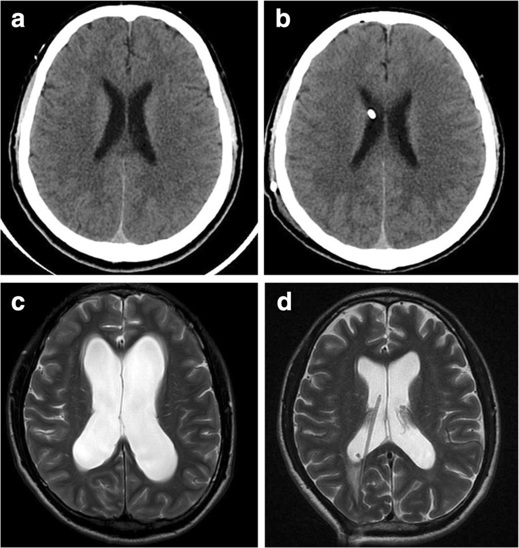 Liu et al. BMC Neurology (2018) 18:58 Page 3 of 8 Fig. 2 a and b Head CT of a 40-year-old VPSWOV patient before and after operation.