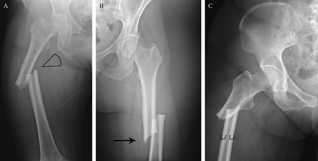 Concerns for side effects: atypical fractures FIGURE 1. Representative radiographs of femoral shaft fractures sustained from minimal trauma in patients taking alendronate.