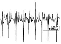brachii EMG power spectrum urns-ampl (A) analysis normal