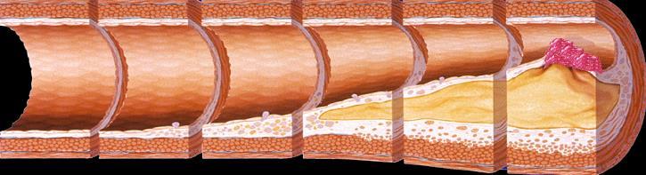 Prevention of Cardiovascular Disease is anchored on preventing or slowing the progression of atherosclerosis Foam Cells Fatty Streak Intermediate Lesion Atheroma Fibrous Plaque Complicated