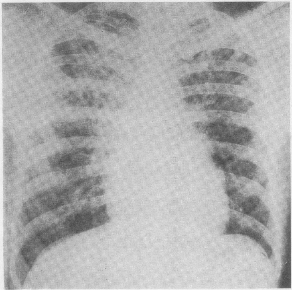 k. FIG. 1. Cas? 1. Chest radiograph extensive opacities in both lungs. -moft,.-il"w.