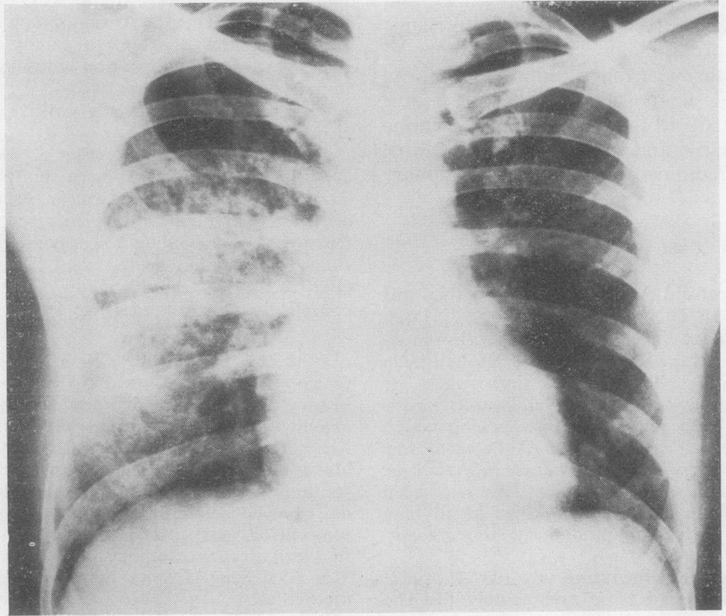 1136/thx.25.6.751 on 1 November 1970. Downloaded from http://thorax.bmj.com/ FIG. 2. Case 1.