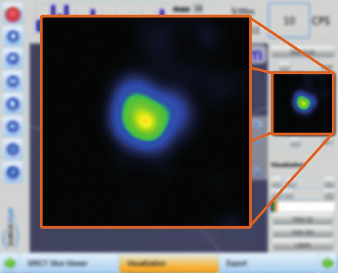Live 2D image: Anytime during the SPECT and ultrasound procedures you can view the live 2D image of the handeld gamma