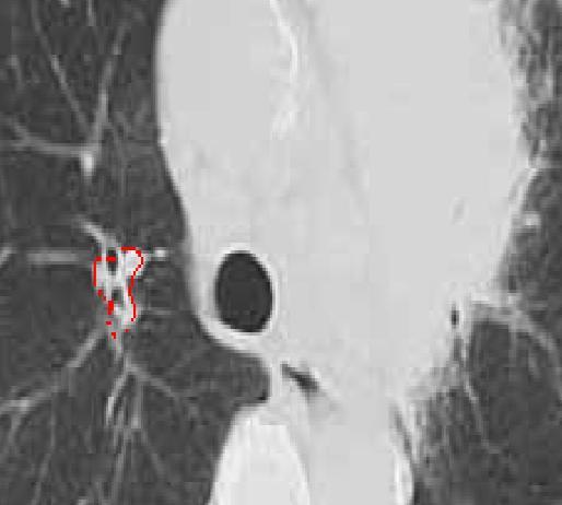 (e) (f) (g) (h) Fig 2 (a) CT Scan of Lungs with Cancer, (b) Filtered Image, (c) Histogram equalized followed by Binarization Image, (d) Sobel Edge Detected Image, (e) Labeled Cancerous Cells (f) Edge