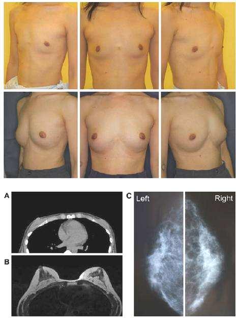 Adipose-derived Stem Cells in Breast Augmentation Preop Oncologic Safety of Adiposederived Stem Cells 40 patients Median F/U ~6 mo No comparison without ASC enrichment At least some patients are
