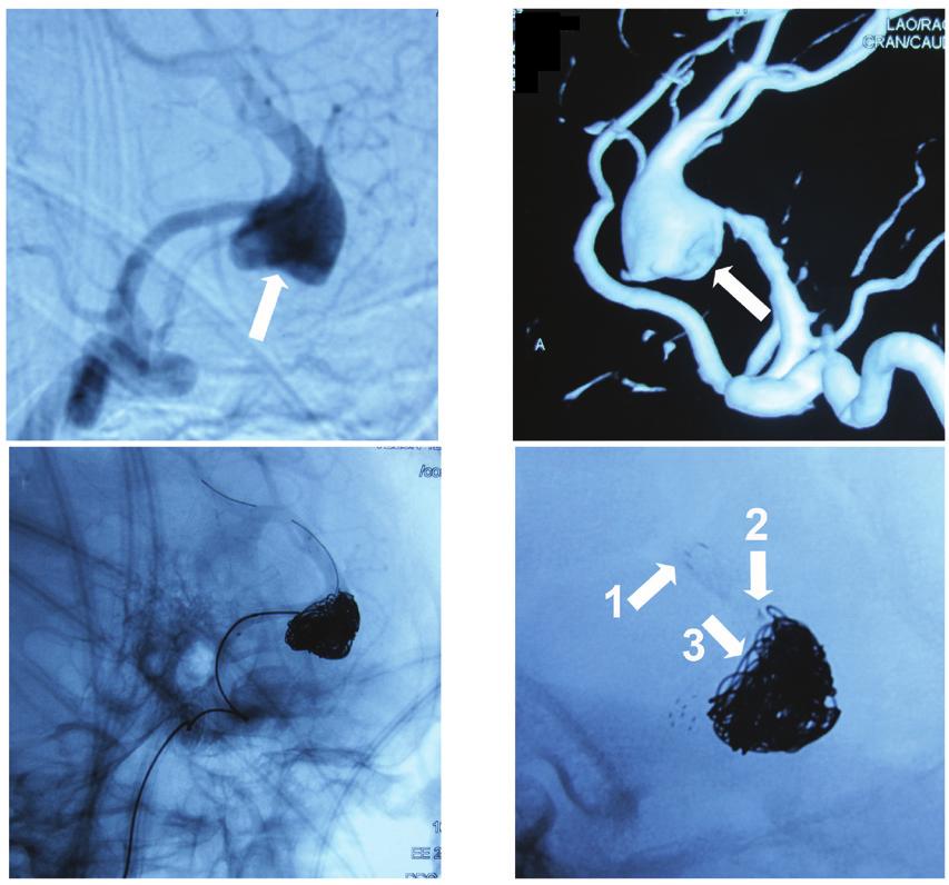 148 YE et al: SOLITAIRE AB AND ENTERPRISE STENT-ASSISTED COILING Table IV. Procedural feasibility and procedure related morbidity in patients treated with stent assisted coiling.