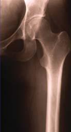 These broken bones, commonly known as fragility fractures (broken bones after a minor