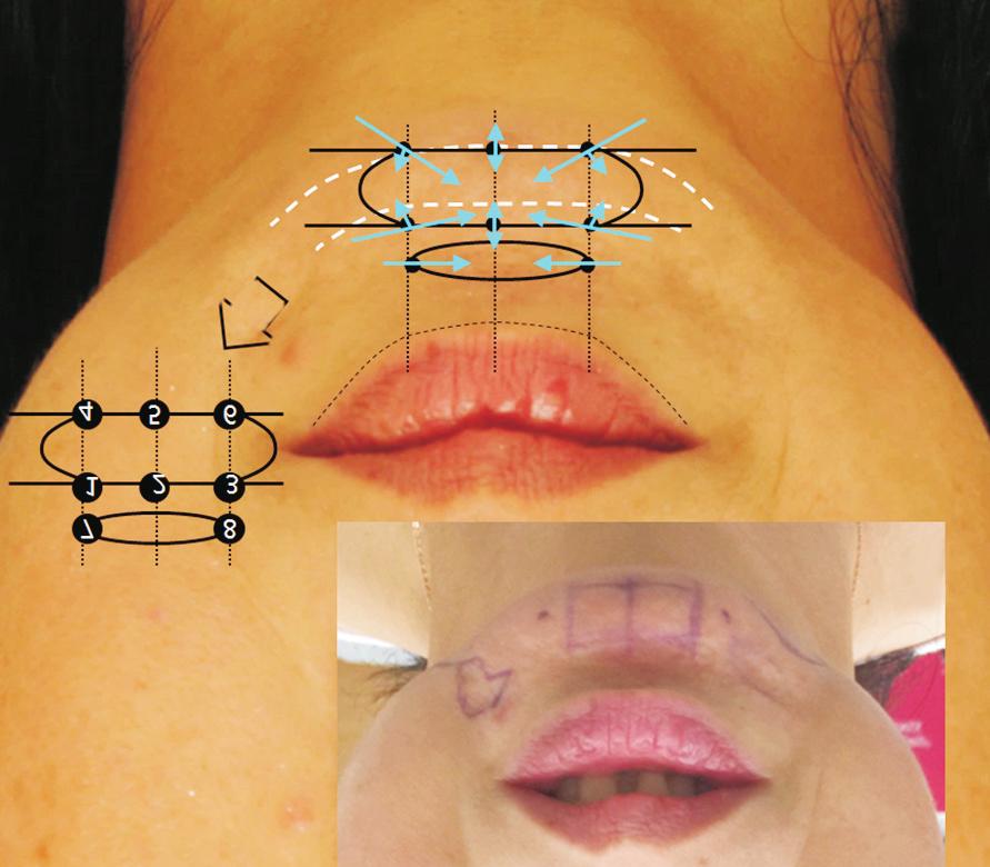 Subperiosteal chin augmentation with hyaluronic acid filler in patients with a small chin the minimal down time and fewer complications.