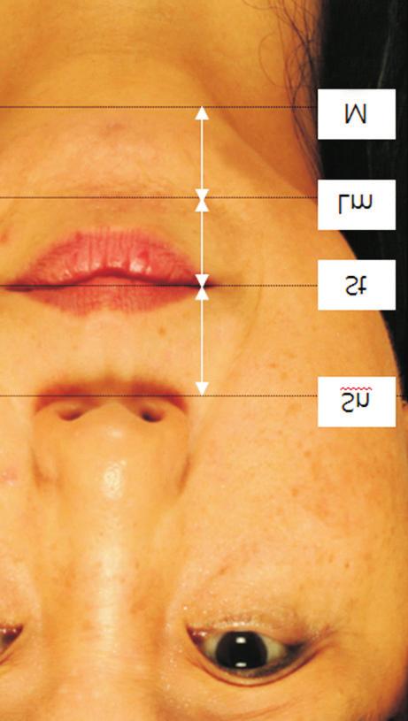 Filler and botulinum toxin injection In the first session of the filler injection, an average of 2.43±0.73 ml of Elravie Premier Ultravolume-L (hyaluronic acid 23mg/ ml, 0.3% lidocaine, Humedix Co.