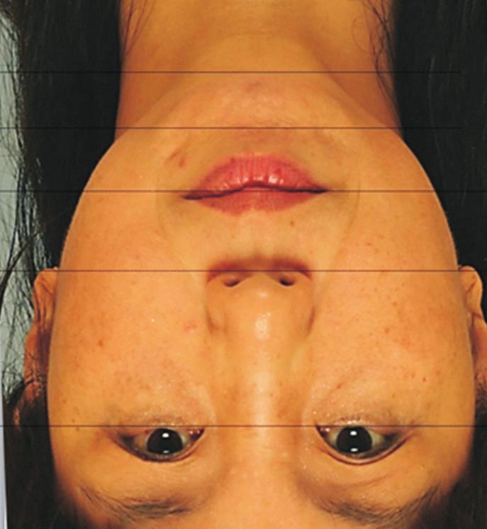 Kyoungjin Kang, Choongyee Chai I II III I II III 21 17.5 C D Fig. 3. Immediate changes of lips after chin augmentation in status of mentalis muscle on animation.