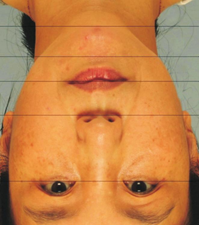 Ltd, Republic of Korea) was also applied only to the fronto-temporoparietal areas for non-invasive face lifting.