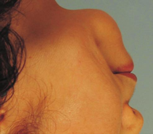 patient, who has been injected man-made filler into intradermal, subcutaneous, and submuscular layers.