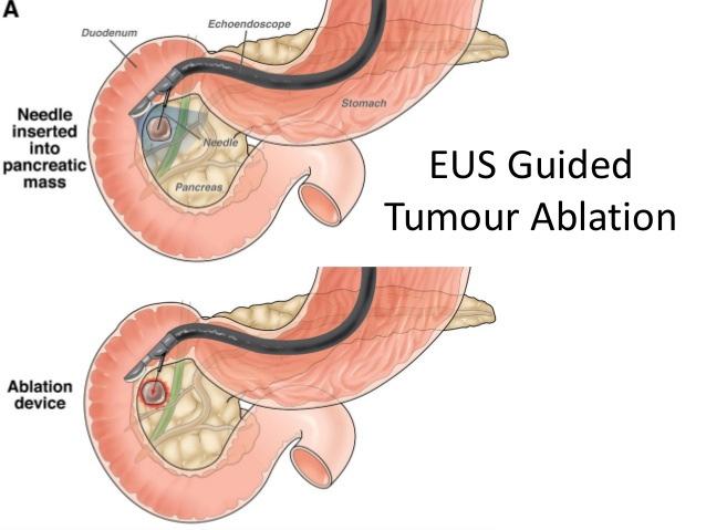 Role of EUS for treatment of p NENs 24 patients with EUS-guided Ethanol