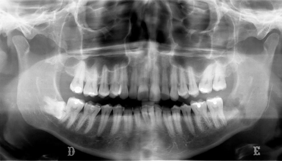 Maria Isabel de Oliveira e Britto Villalobos et al Fig. 8. Panoramic radiograph showing the stabilized fragment at 3 months of monitoring. Fig. 9.