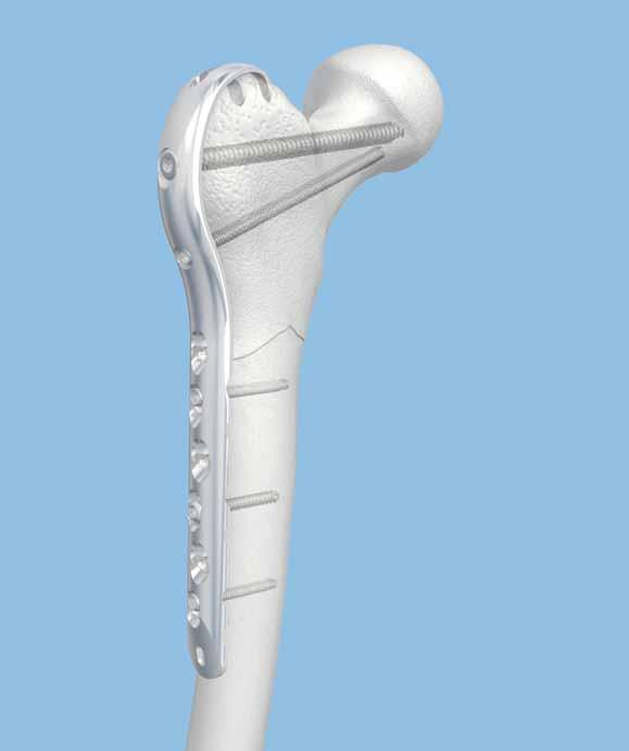 Technique Guide LCP Proximal Femoral Hook Plate 4.