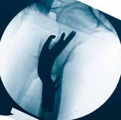 intertrochanteric reversed or transverse or with additional fracture of the