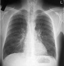 Pneumonia and LRTI The presence of underlying 