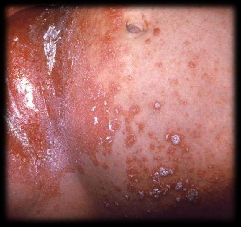 Fungal Skin Infections Must have Both Characteristic rash or lesions AND Fungal Rash