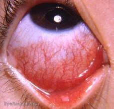One of the following Conjunctivitis Considerations Pus from one or both eyes, present for at least 24 hrs New/increased conjunctival erythema, with or without