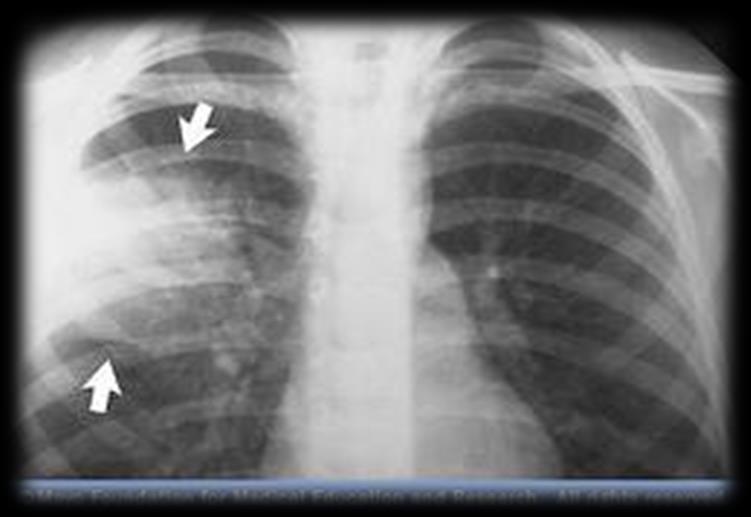 reduce 3% from baseline New/changed lung exam abnormalities Pleuritic chest pain RR >/=