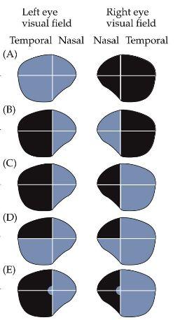 16. Types of Visual Field Deficits Right monocular blindness Bitemporal hemianopsia Left