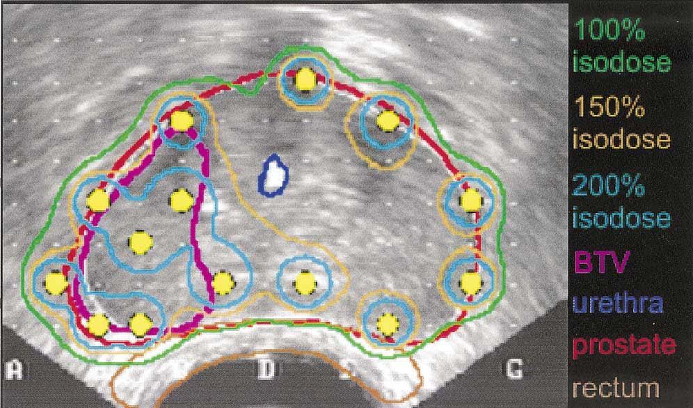 Another example of an ultrasound sonograph Ultrasound sonograph in 2D with prostate in red, the biological tumor volume