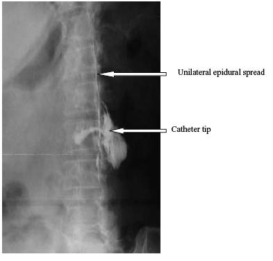 Complications Inadvertant spinal or epidural anesthesia Don t deviate medially