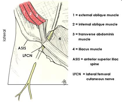 Lateral Femoral