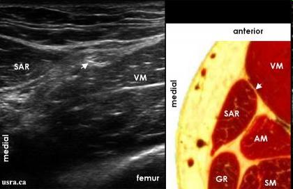 Sub-sartorial 5-7 cm proximal to knee Lateral-medial
