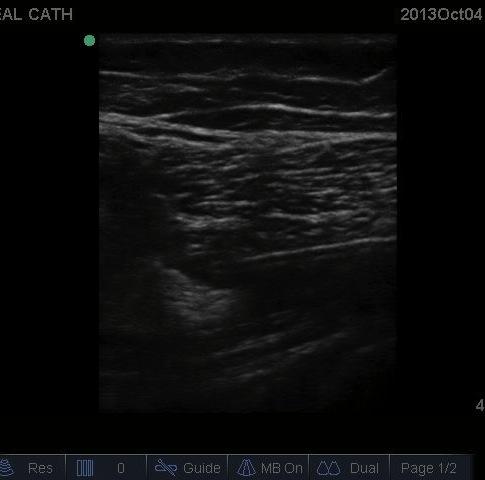 US view in supine position Popliteal Artery Nerve