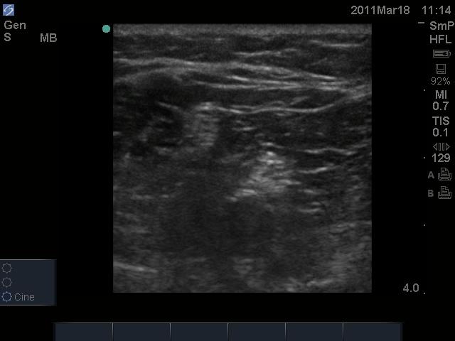 Popliteal Lateral Approach with