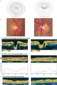 It shows shrunken superior portion of the optic disc with thinned nerve fibre layer and extension of a complex of retinal pigment epithelium and choroid towards the centre of the optic disc.