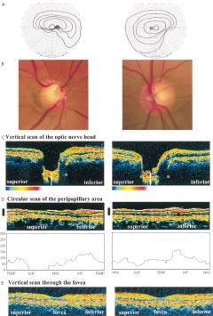 912 Unoki, Ohba, Hoyt Figure 3 Patient 3. Left panels: right eye; Right panels: left eye. Both eyes have SSOH. (A) Visual fields.