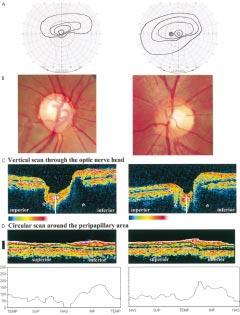 Topless optic disc 913 Figure 5 Patient 5. Left panels: right eye; Right panels: left eye. Both eyes have SSOH. (A) Visual fields. An inferior altitudinal defect is demonstrated in right eye.