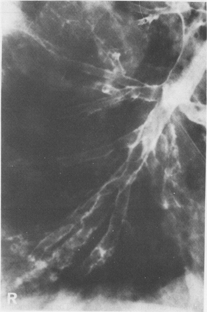 Assessment of bronchiectasis by computed tomography R k Fig 1 (Above) Computed tomography scan of lungs showing bronchial wall thickening and dilatation in both lower lobes, with