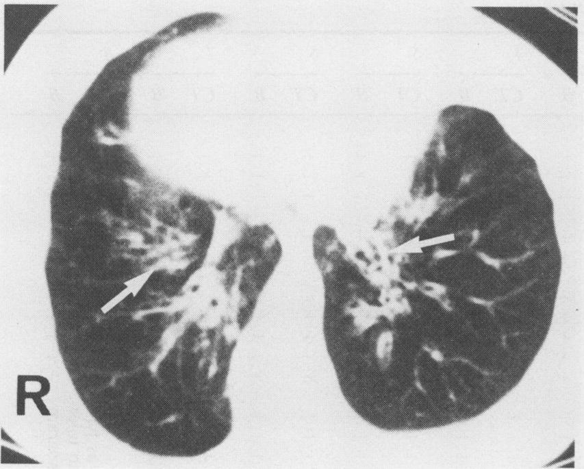 (Right) Bronchogram from the same patient: oblique view of right lower lobe showing bronchial dilatation. dently by one radiologist (RSOR) without knowledge of other findings.