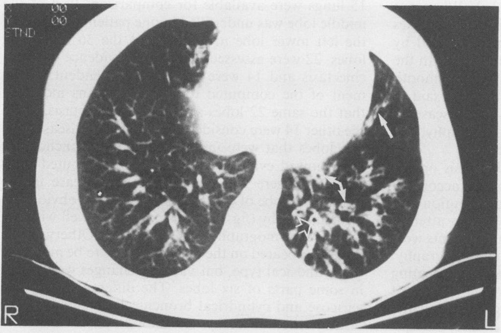 The presence of bronchiectasis as seen on bronchography was recorded to include its type (cystic, varicose, or cylindrical), lobar distribution within each lung, and, within each