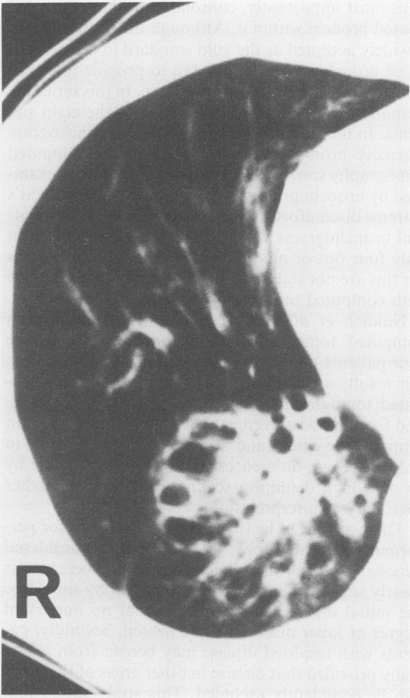Assessment of bronchiectasis by computed tomography Fig 3 (a) Right lung bronchogram showing cystic bronchiectasis in the right lower lobe corresponding with the computed tomography appearances.