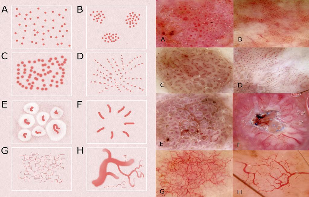 lines that may be seen with both polarizing and non-polarizof pigmented lesions, for non-pigmented lesions dermatoscopic features must be supplemented by clinical findings to achieve acceptable