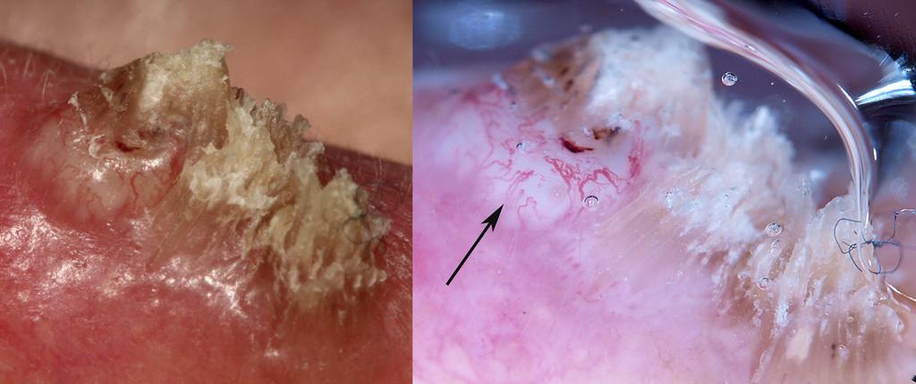 Figure 5. Surface keratin and a white structureless area are seen clearly on the close-up clinical image of a non-pigmented raised lesion on the ear of a 60-year-old man (left).