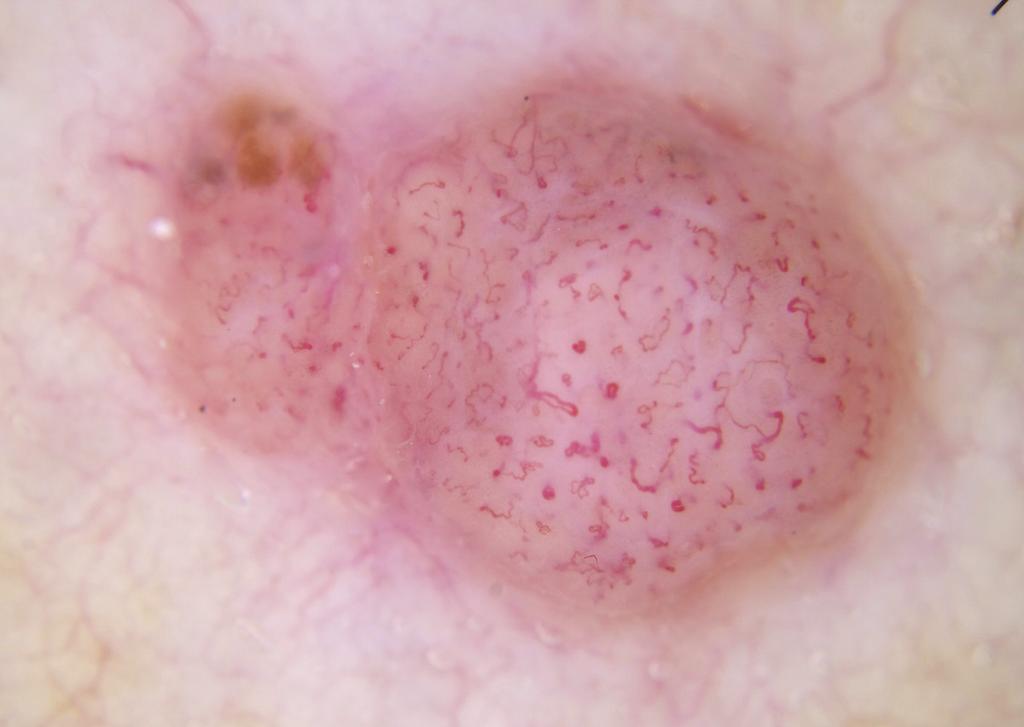 Figure 7. Dermatoscopic image of a non-pigmented lesion. There is no ulceration and there are no white clues (as defined in the text).