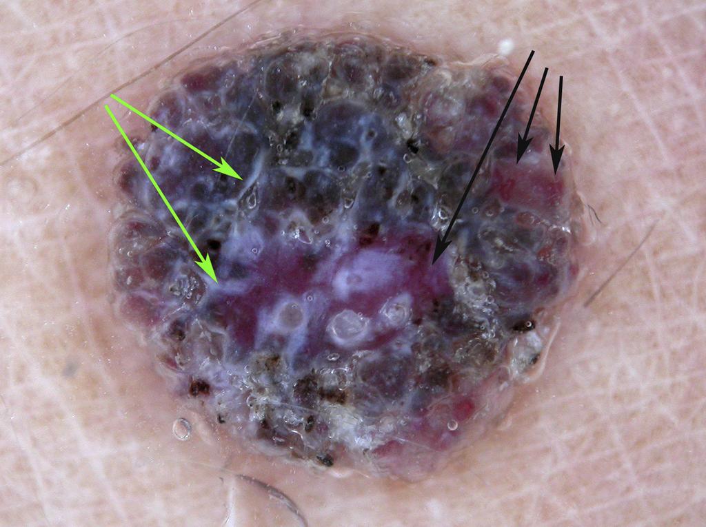 A polymorphous pattern of vessels, including a pattern of dot vessels, raises suspicion for melanoma. This was an invasive amelanotic melanoma (Breslow thickness 0.3 mm).