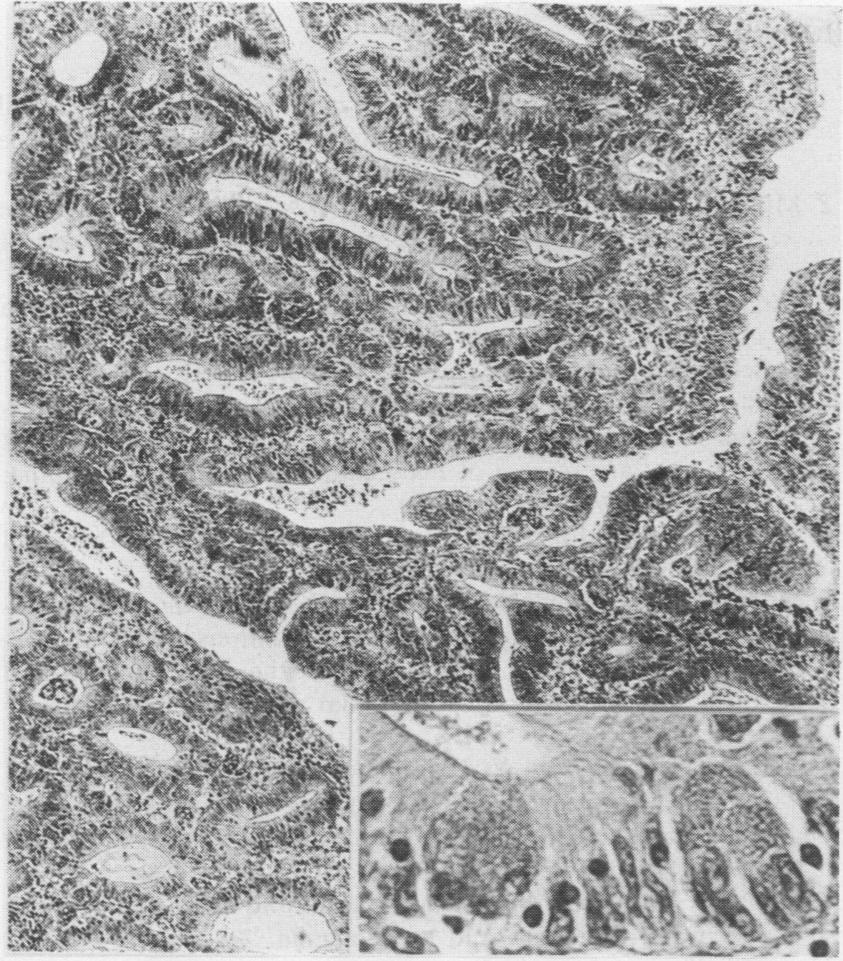 Adenomatosis of small intestine Fig 6 High power view offig 5 showing tubular adenoma.