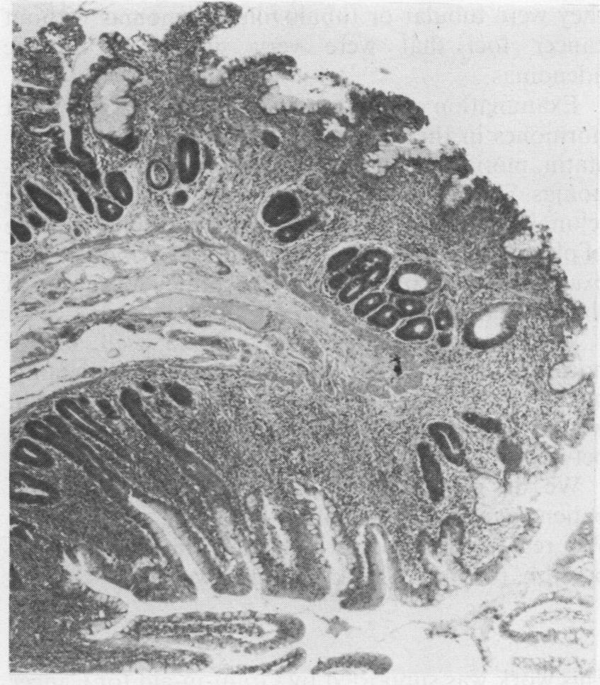with severe atrophy of Lieberkuhn 's glands and proliferation Stratification can be seen, but there is nofocus ofcancer. ofplasma cells in resectedjejunal mucosa.