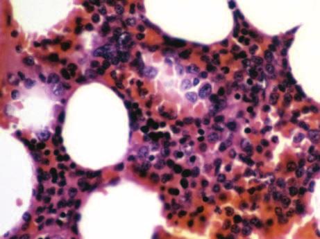 Obtaining the bone marrow biopsy 3 cytochemistry, immunophenotyping, cytogenetic analysis, and molecular genetic study. Clot biopsy sections are often made from coagulated aspirate material.