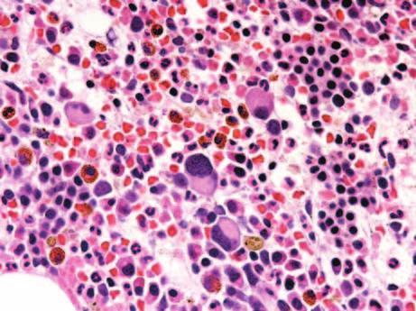 Alternatively, when EDTAanticoagulated aspirate specimens are used, the bone marrow particles that are left after smears are prepared can be filtered and embedded for histologic evaluation (Arber et