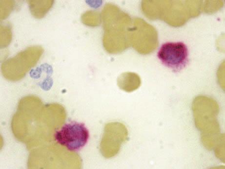 The other cytochemical test that is commonly used on bone marrow (and peripheral blood) smears is the detection of tartrate-resistant acid phosphatase (Fig. 2.