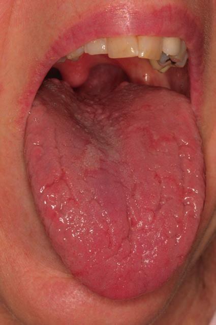 7 Fissured tongue with extensive grooves and fissures over the entire dorsal surface. Biopsy: No. Fig. 2.