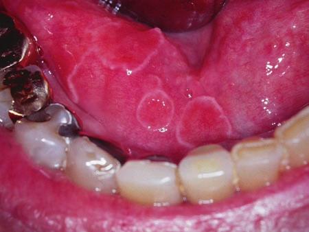 Other oral mucosal sites can be affected less frequently, in which case the condition is called stomatitis erythema migrans or ectopic geographic tongue.